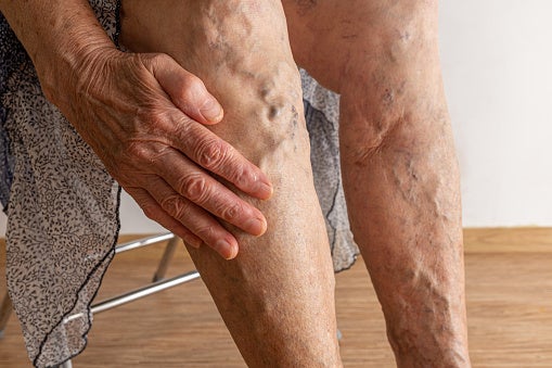 Unrecognizable senior woman hand show bare legs with varicose veins inflammation. Checking health for thrombosis, thrombophlebitis, embolism issue. Need laser surgery operation for medical condition